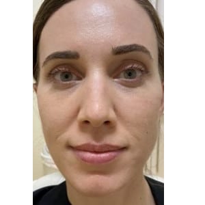 After Image: Hydraneedle after 1st treatment - front