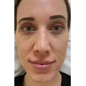 Before Image: Hydraneedle after 1st treatment - front