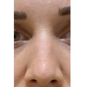 After Image: Hydraneedle after 1st treatment - front