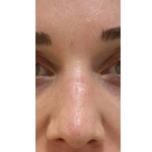 Before Image: Hydraneedle after 1st treatment - front