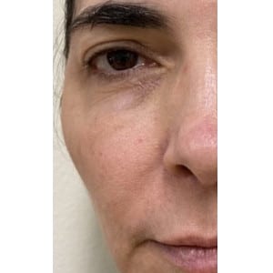 Before Image: Hydraneedle after 1st treatment - front