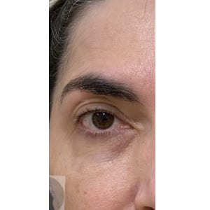 After Image: Airgent Kinetic Lift after 1 treatment - front