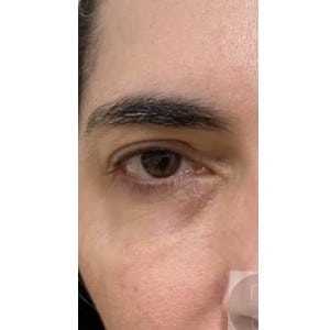 Before Image: Airgent Kinetic Lift after 1 treatment - front