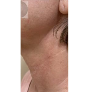 After Image: Airgent Neck lines after 3 treatments - left-side
