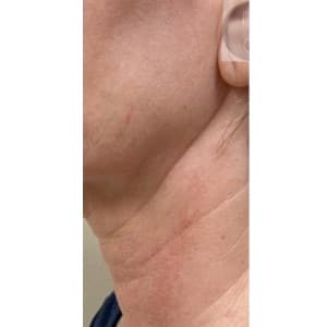 Before Image: Airgent Neck lines after 3 treatments - left-side