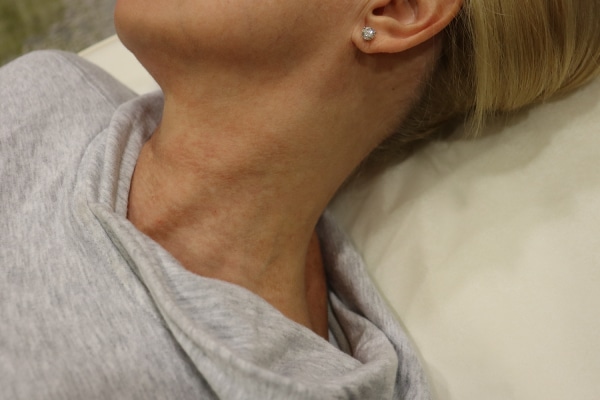 After Image: AdvaTx and IPL - front