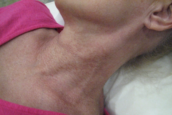 Before Image: AdvaTx and IPL - front