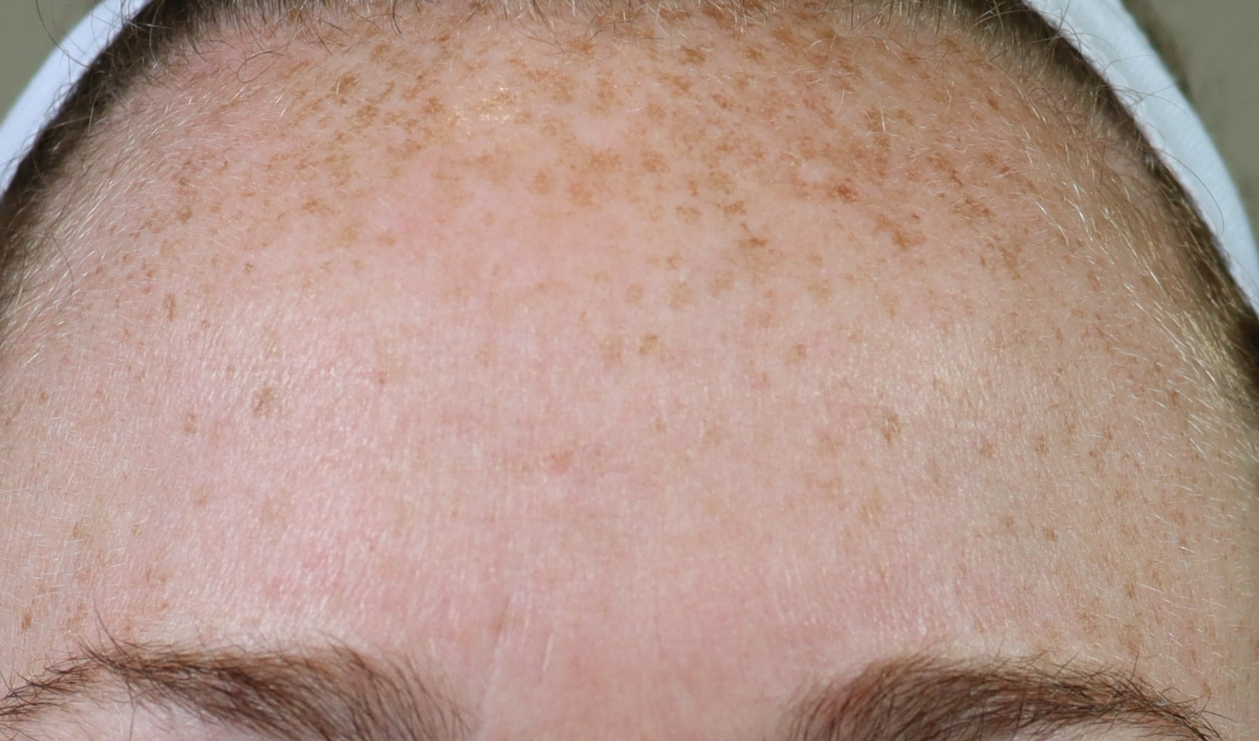 Before Image: Forehead IPL - front