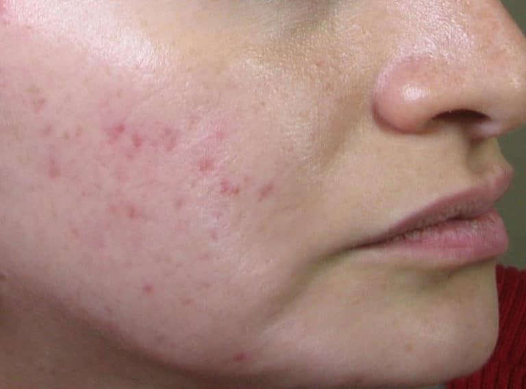 Before Image: IPL and Microneedling - front