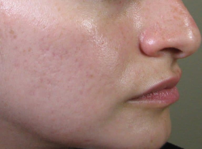 After Image: IPL and Microneedling - front