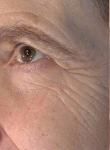 Before Image: Vivace After 6 Treatments - front