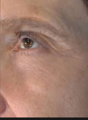 After Image: Vivace After 6 Treatments - front