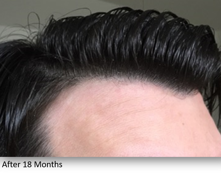 After Image: Keralase - right-front-oblique