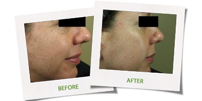 1772096046_Eclipse-Micropen-Elite2 Eclipse Micropen Elite2