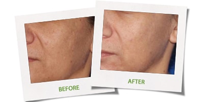 1772096052_Eclipse-Micropen-Elite3 Eclipse Micropen Elite3