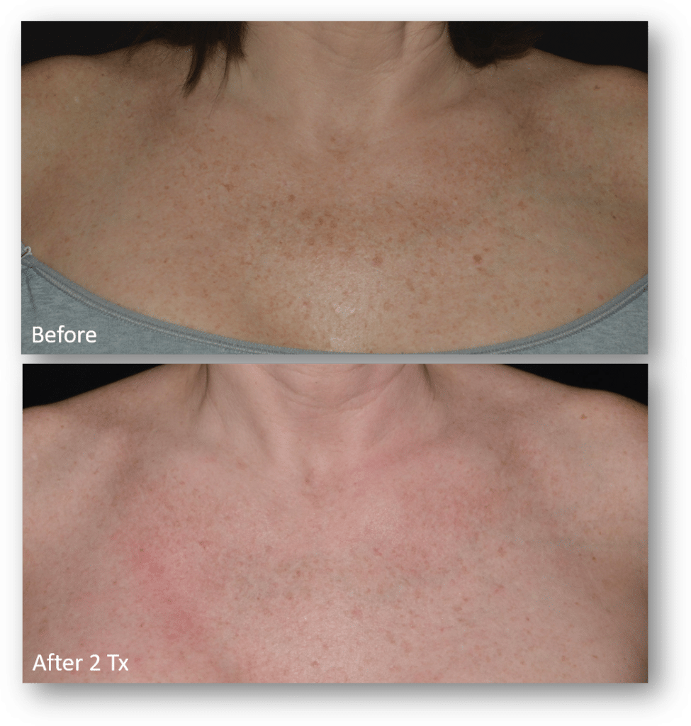 1772096428_LaseMD-Ultra-BA-23-for-website 1772096428 LaseMD Ultra BA 23 for website 1