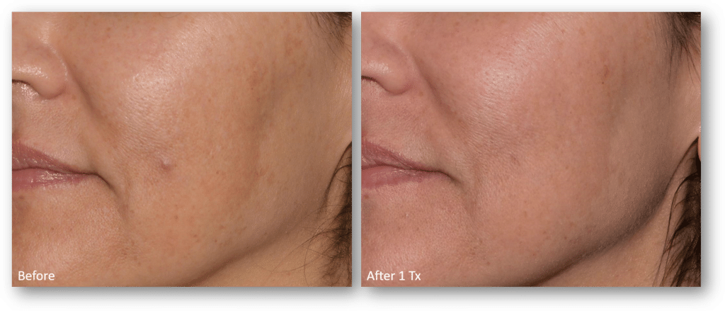 1772096435_LaseMD-Ultra-BA-22-1-for-website 1772096435 LaseMD Ultra BA 22 1 for website 1