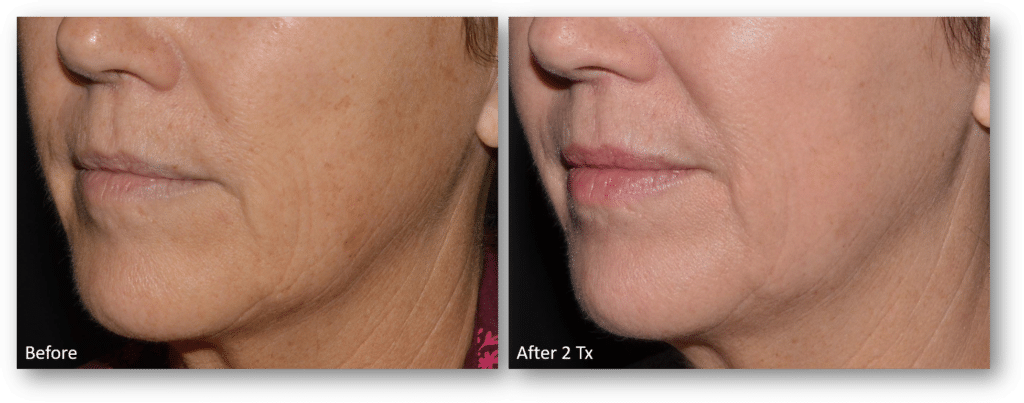 1772096442_LaseMD-Ultra-BA-15-for-website 1772096442 LaseMD Ultra BA 15 for website 1