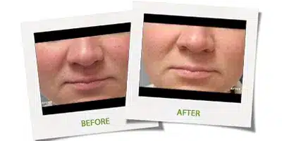 Chemical Peels4.jpg 1