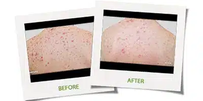 Glytone Chemical Peels.jpg