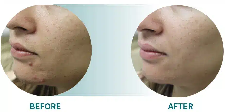 Gold Acne Female1B 1.jpg