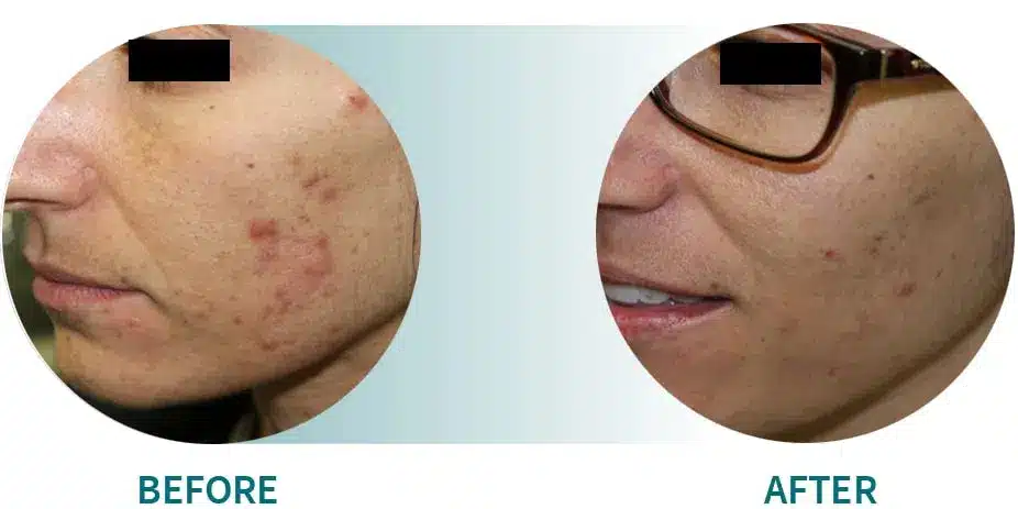 Gold Acne Female2A finish 2.jpg