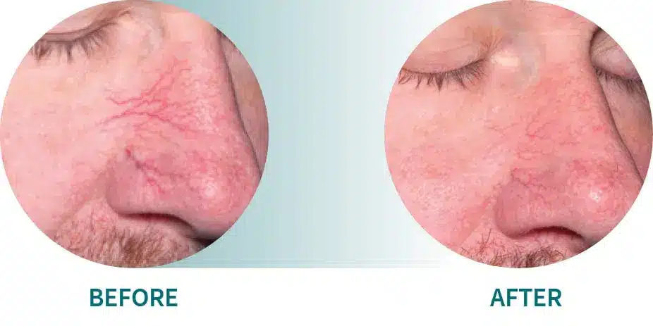 advalight-before-after-nose-1-1.jpg advalight before after nose 1 1.jpg